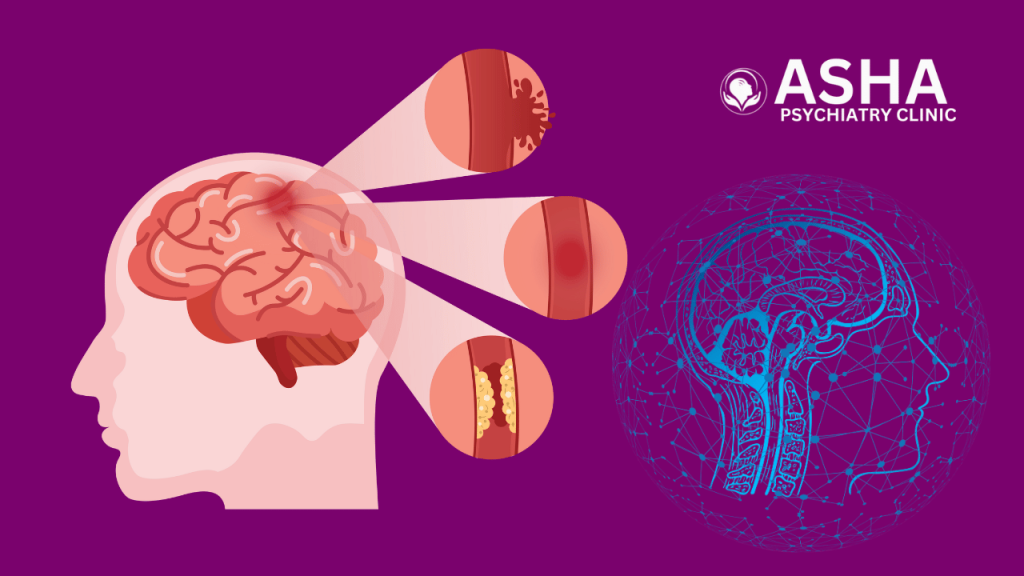 brain fog